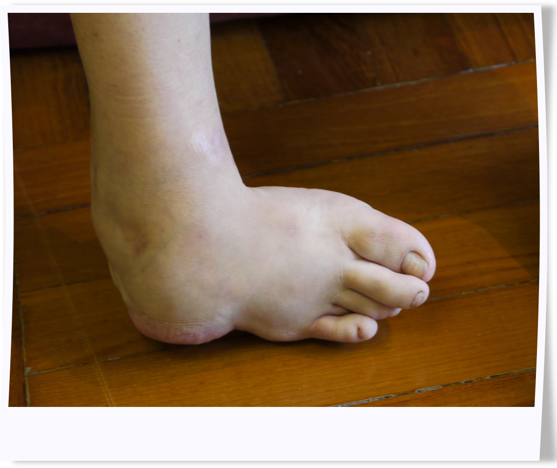 Xiao Yan with a deformed right foot