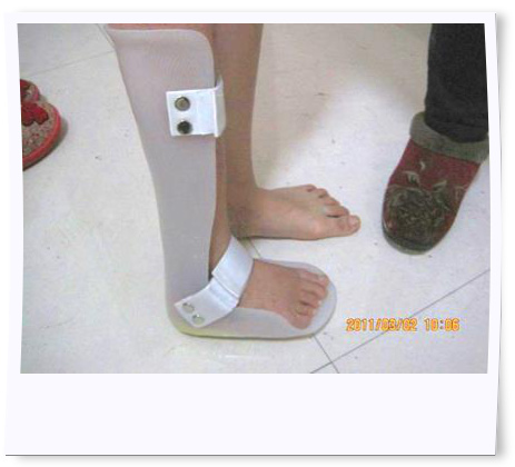 Her foot is applied with orthosis