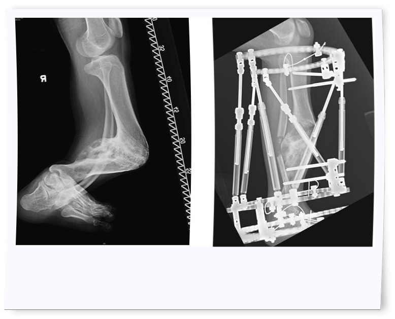 矯形前及矯形後的X光片