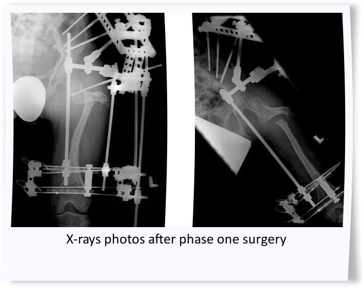 X-ray after phase one surgery