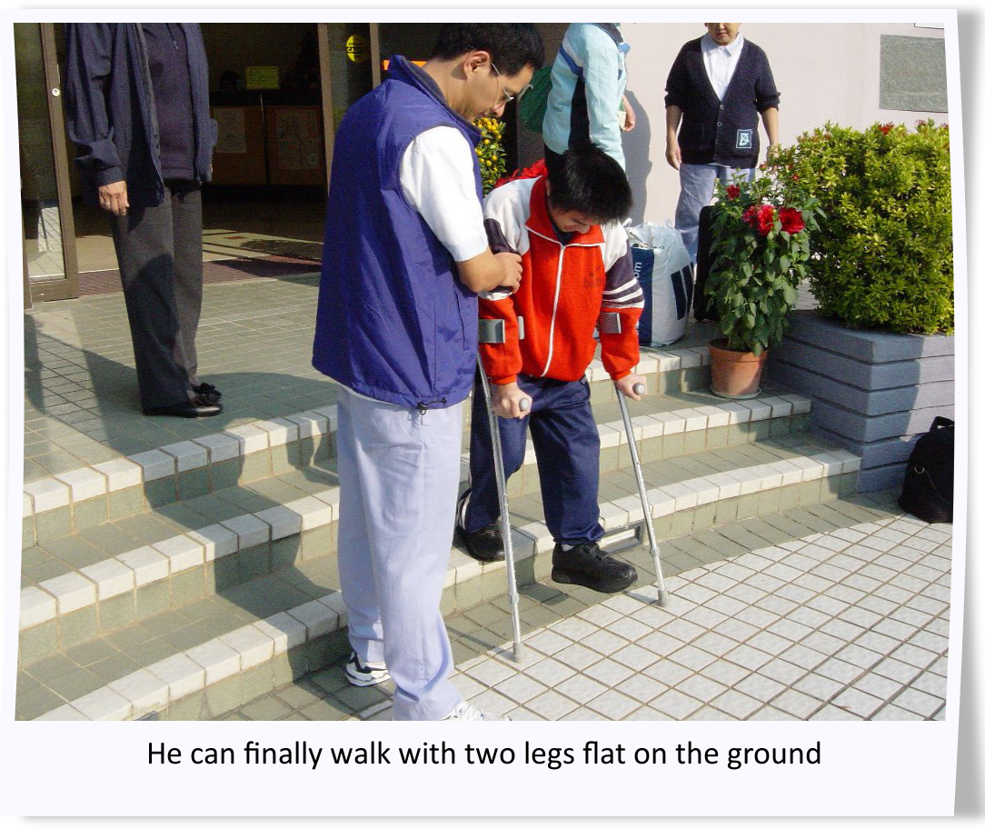 he can finally walk with two legs flat on the ground