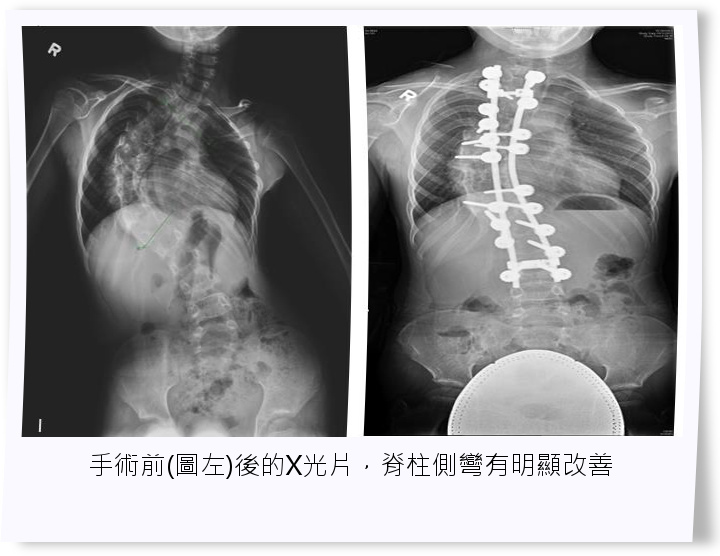 手術前後的X光片，脊柱側彎有明顯改善